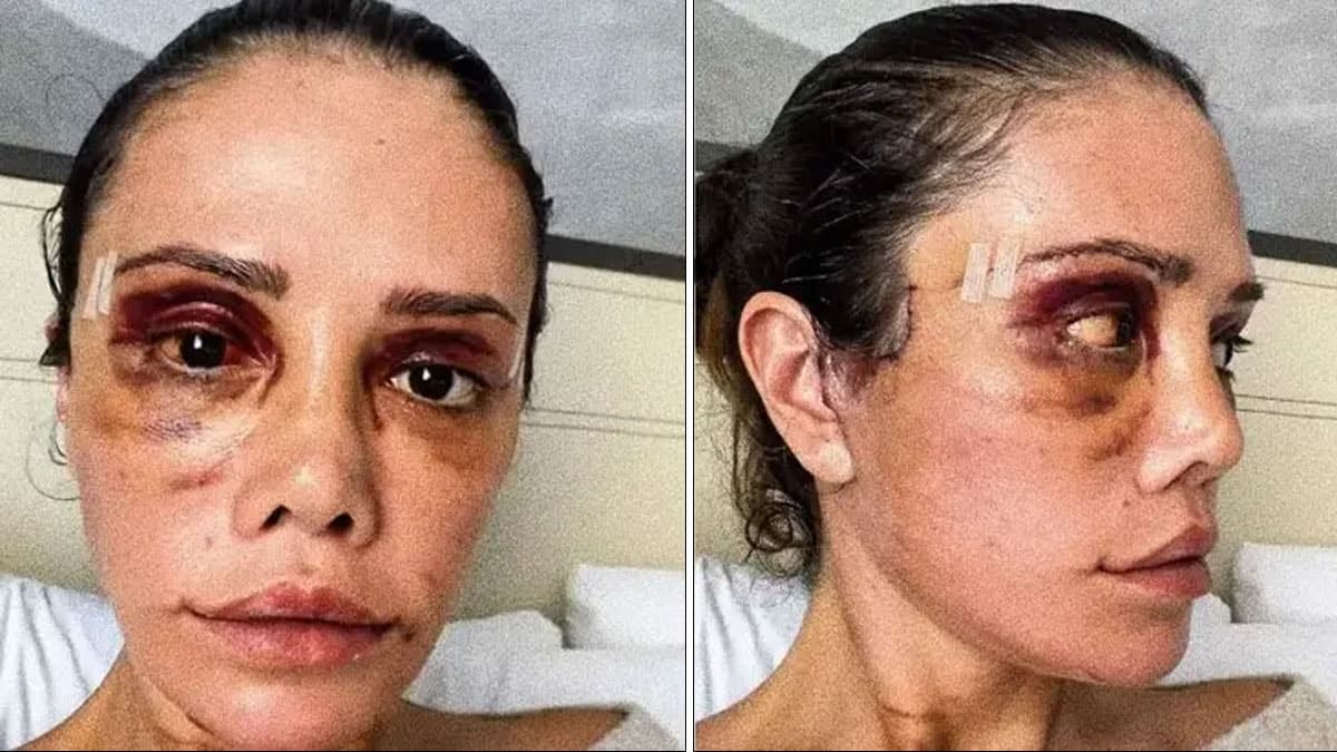 İkinci yüz nakli sonrası felç geçiren Didem Ceran'dan yeni karar